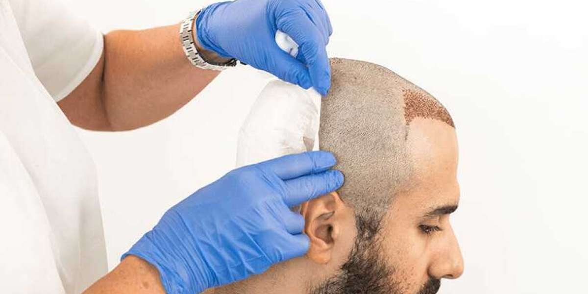 Is Hair Transplant Permanent Solution for Hair Loss?